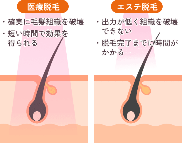 医療脱毛とエステ脱毛の違いを説明する画像