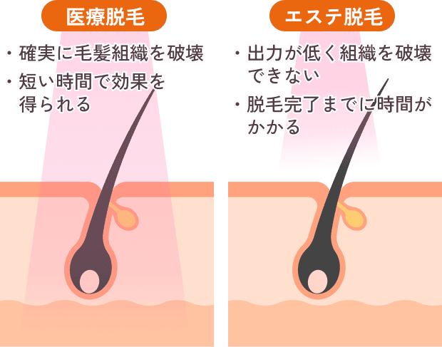 医療脱毛とエステ脱毛の違いを説明する画像