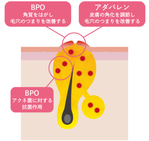 【医療従事者監修】黄ニキビ（嚢胞ニキビ）とは？原因や対処法まで詳しく解説 | ニキビ、ニキビ跡、赤ら顔の改善なら渋谷美容外科クリニック