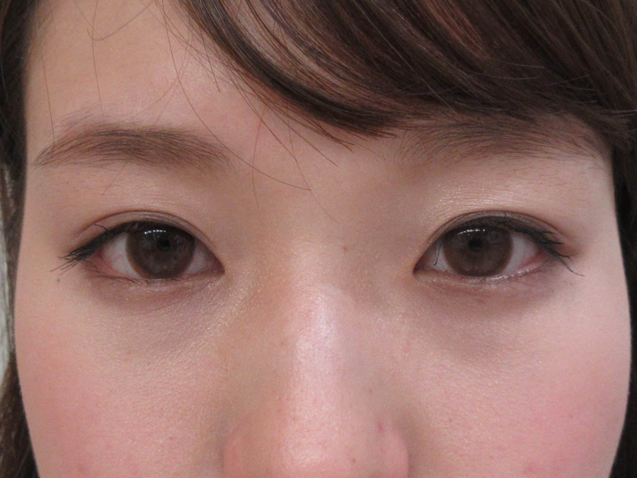 二重まぶた・目もとの症例写真 | 【公式】美容整形・美容外科なら渋谷美容外科クリニック