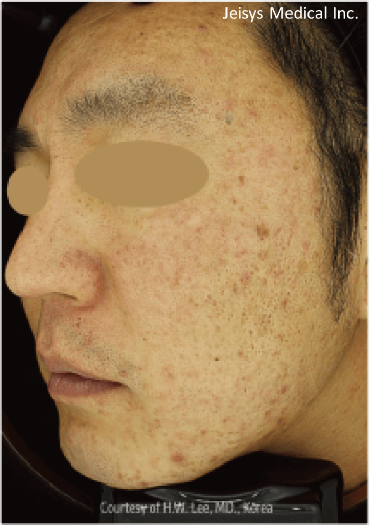 【医療従事者監修】黄ニキビ（嚢胞ニキビ）とは？原因や対処法まで詳しく解説 | ニキビ、ニキビ跡、赤ら顔の改善なら渋谷美容外科クリニック