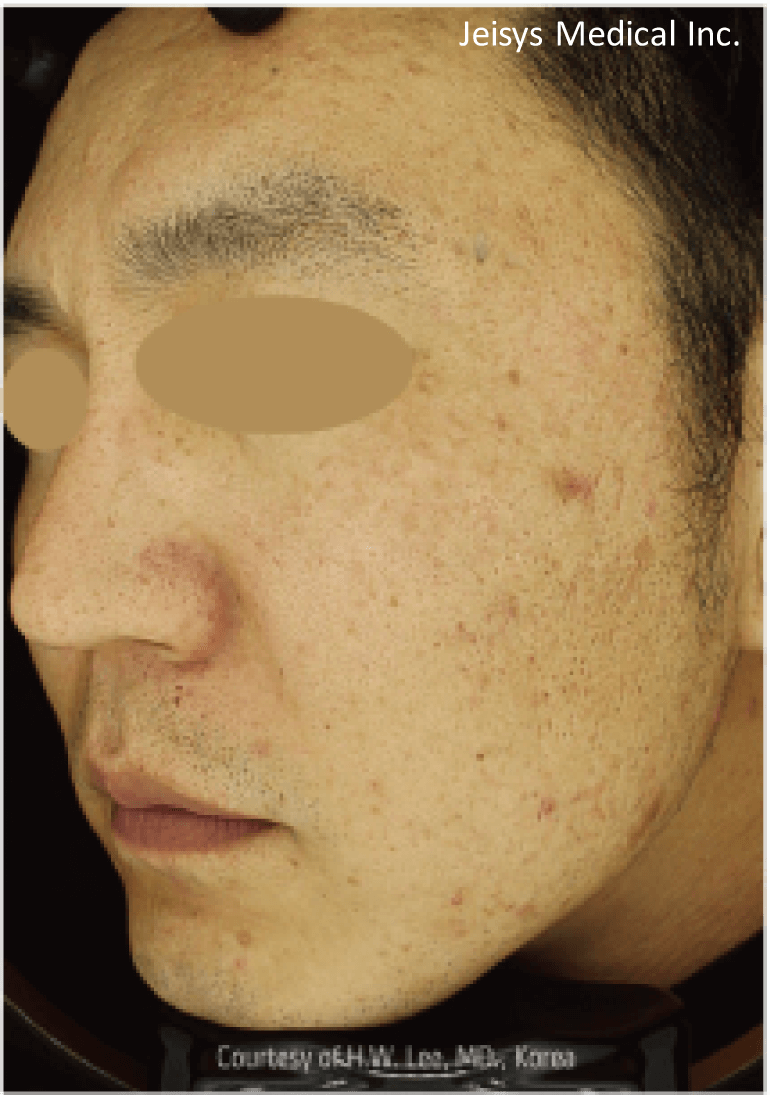 【医療従事者監修】黄ニキビ（嚢胞ニキビ）とは？原因や対処法まで詳しく解説 | ニキビ、ニキビ跡、赤ら顔の改善なら渋谷美容外科クリニック