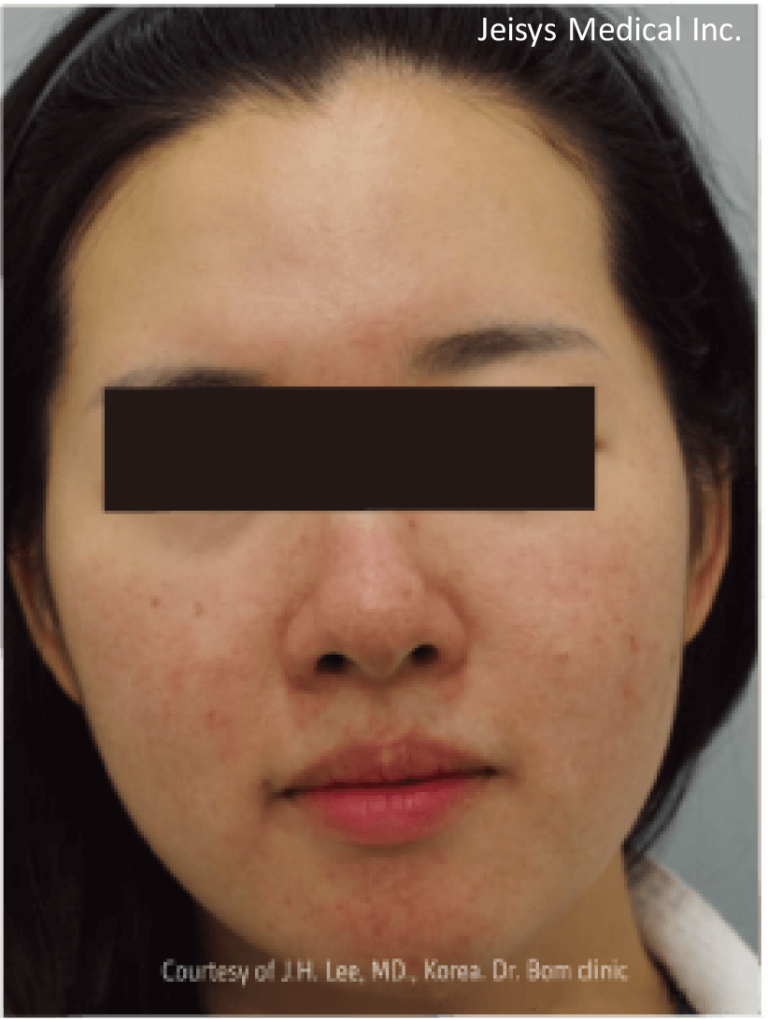 【医療従事者監修】黄ニキビ（嚢胞ニキビ）とは？原因や対処法まで詳しく解説 | ニキビ、ニキビ跡、赤ら顔の改善なら渋谷美容外科クリニック