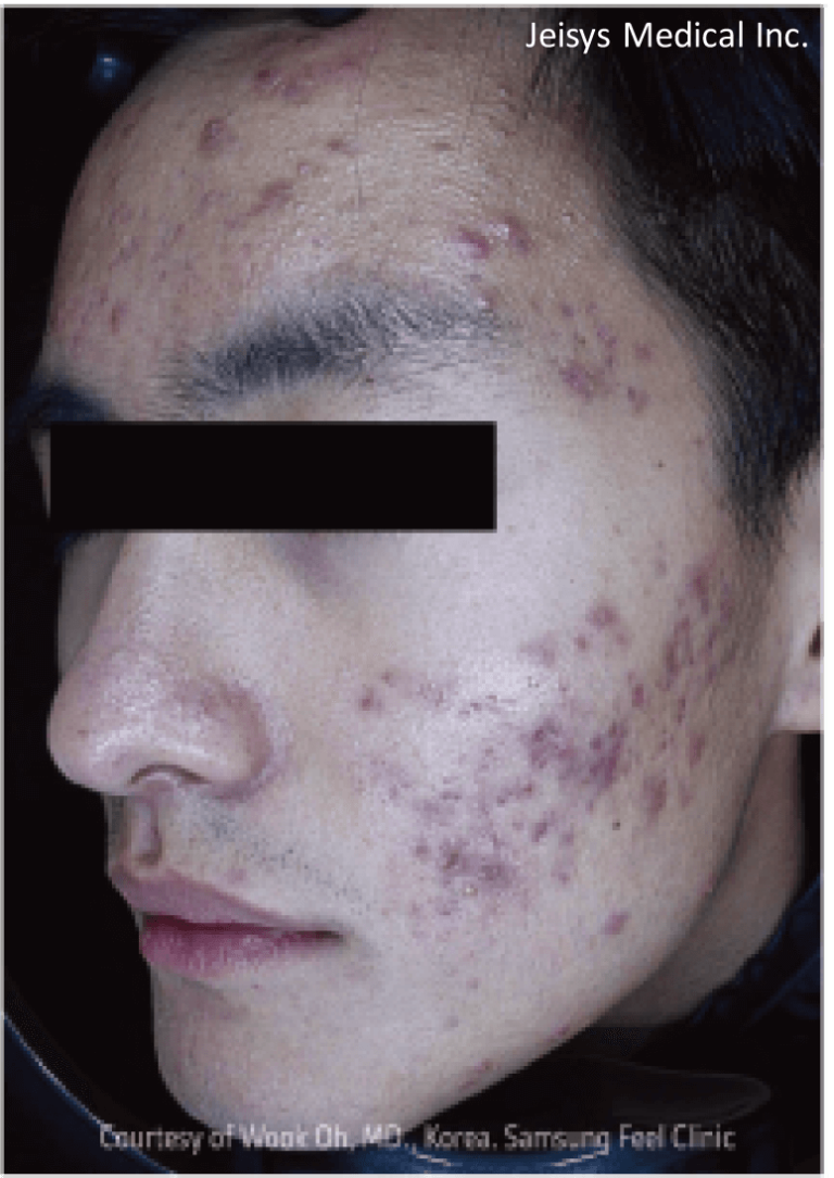 【医療従事者監修】黄ニキビ（嚢胞ニキビ）とは？原因や対処法まで詳しく解説 | ニキビ、ニキビ跡、赤ら顔の改善なら渋谷美容外科クリニック