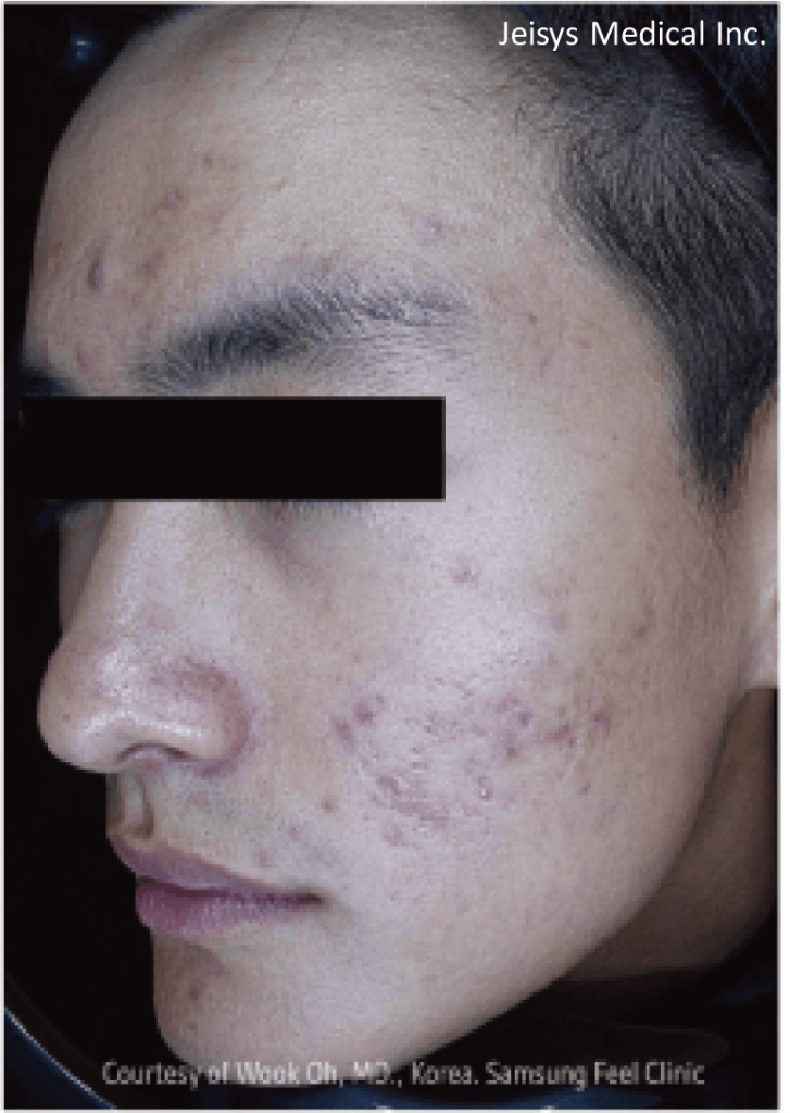 【医療従事者監修】黄ニキビ（嚢胞ニキビ）とは？原因や対処法まで詳しく解説 | ニキビ、ニキビ跡、赤ら顔の改善なら渋谷美容外科クリニック