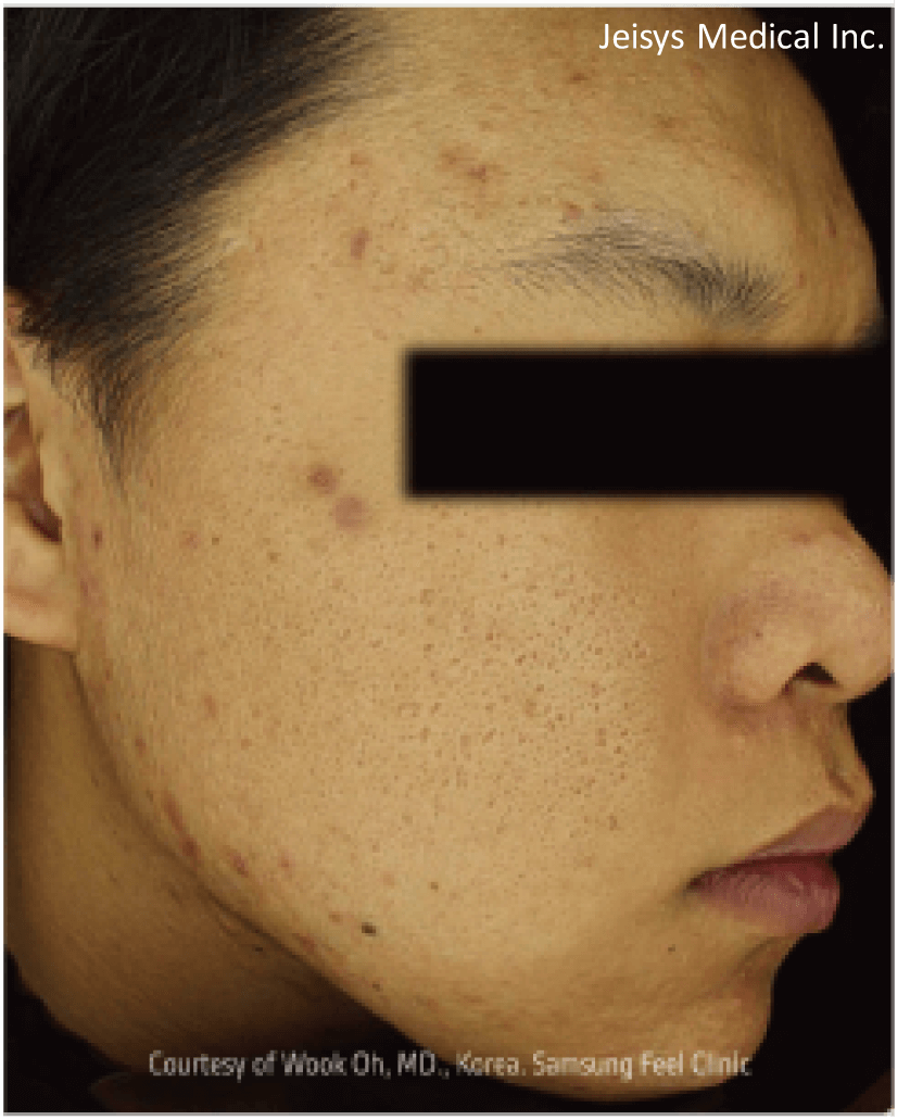 【医療従事者監修】黄ニキビ（嚢胞ニキビ）とは？原因や対処法まで詳しく解説 | ニキビ、ニキビ跡、赤ら顔の改善なら渋谷美容外科クリニック