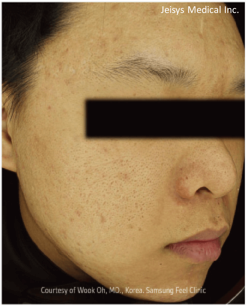 【医療従事者監修】黄ニキビ（嚢胞ニキビ）とは？原因や対処法まで詳しく解説 | ニキビ、ニキビ跡、赤ら顔の改善なら渋谷美容外科クリニック