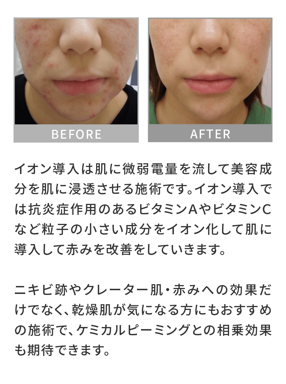 【医療従事者監修】黄ニキビ（嚢胞ニキビ）とは？原因や対処法まで詳しく解説 | ニキビ、ニキビ跡、赤ら顔の改善なら渋谷美容外科クリニック