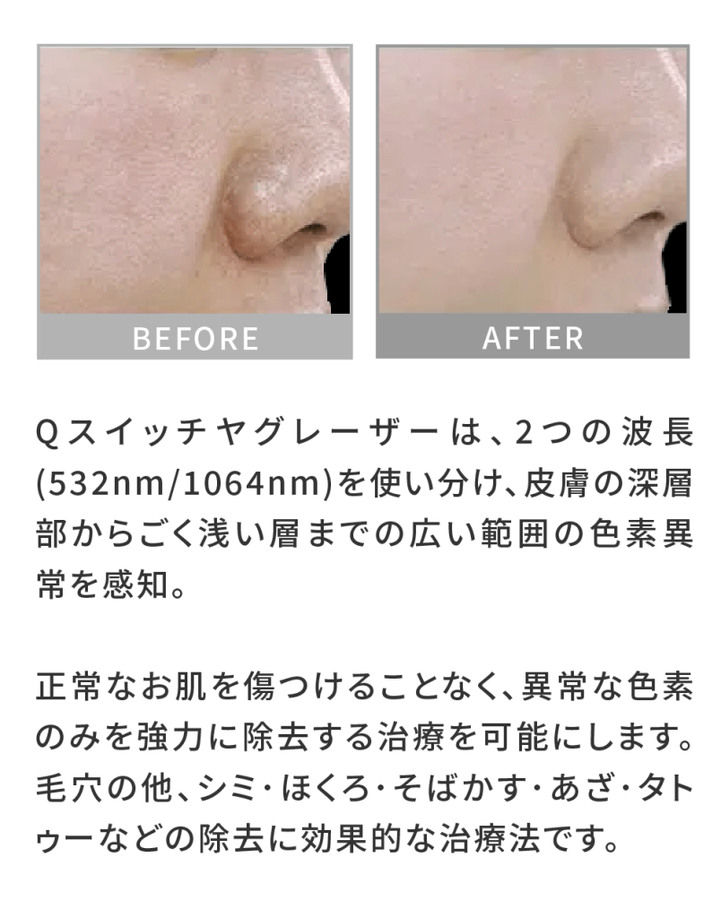 黒ニキビ 治し方 自力