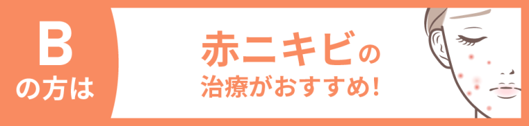 【医療従事者監修】黄ニキビ（嚢胞ニキビ）とは？原因や対処法まで詳しく解説 | ニキビ、ニキビ跡、赤ら顔の改善なら渋谷美容外科クリニック