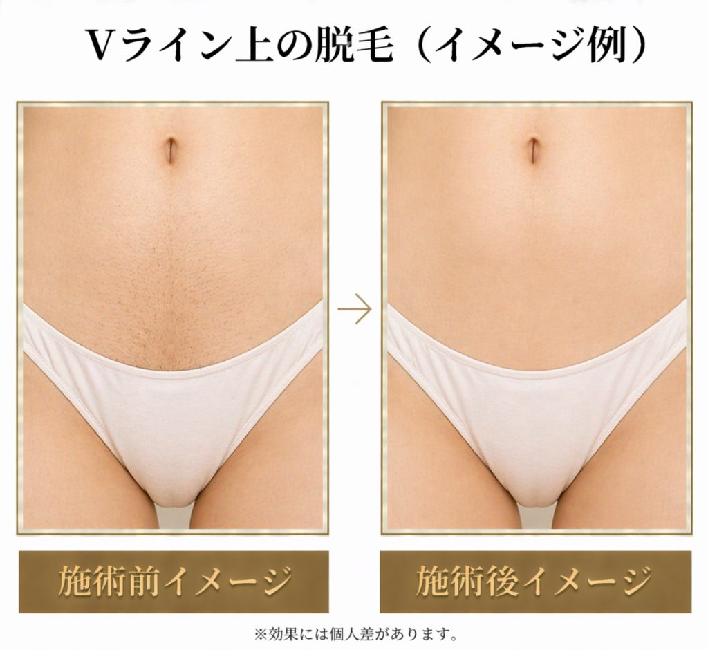 v ライン 脱毛 写真