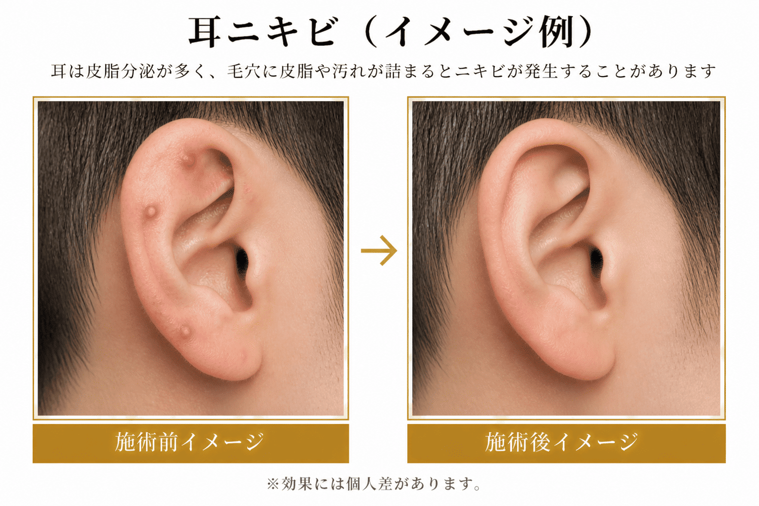 耳 の 中 に ニキビ