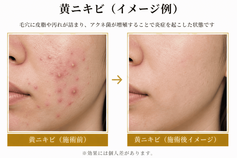 【医療従事者監修】黄ニキビ（嚢胞ニキビ）とは？原因や対処法まで詳しく解説 | ニキビ、ニキビ跡、赤ら顔の改善なら渋谷美容外科クリニック